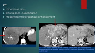 CT:
 Hypodense mass
 Central scar – Calcification
 Predominant heterogenous enhancement
 