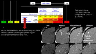 reduction in enhancement resulting in portal
venous phase or delayed phase hypo-
enhancement relative to liver.
Delayed phase
usually should be
acquired at around
3-5 mints
 