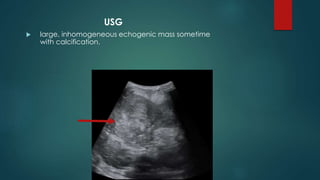USG
 large, inhomogeneous echogenic mass sometime
with calcification.
 