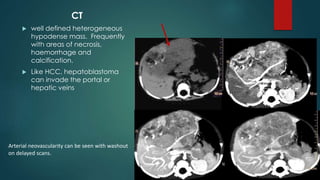 CT
 well defined heterogeneous
hypodense mass. Frequently
with areas of necrosis,
haemorrhage and
calcification.
 Like HCC, hepatoblastoma
can invade the portal or
hepatic veins
Arterial neovascularity can be seen with washout
on delayed scans.
 