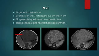 MRI:
 T1: generally hypointense
 C+ (Gd): can show heterogeneous enhancement
 T2 : generally hyperintense compared to liver
 areas of necrosis and haemorrhage are common
 