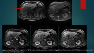 Appears hypoint on T1 and hyperint on T2 WI & Shows Heterogeneous predominantly peripheral enhancement which becomes more extensive
and central on the delayed images.
 