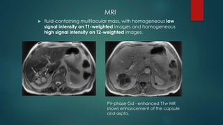 MRI
 fluid-containing multilocular mass, with homogeneous low
signal intensity on T1-weighted images and homogeneous
high signal intensity on T2-weighted images.
PV-phase Gd - enhanced T1w MR
shows enhancement of the capsule
and septa.
 