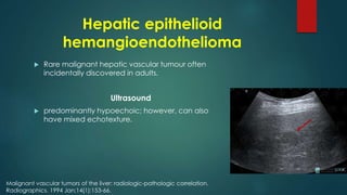 Hepatic epithelioid
hemangioendothelioma
 Rare malignant hepatic vascular tumour often
incidentally discovered in adults.
Ultrasound
 predominantly hypoechoic; however, can also
have mixed echotexture.
Malignant vascular tumors of the liver: radiologic-pathologic correlation.
Radiographics. 1994 Jan;14(1):153-66.
 