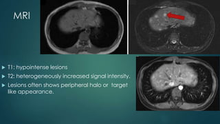 MRI
 T1: hypointense lesions
 T2: heterogeneously increased signal intensity.
 Lesions often shows peripheral halo or target
like appearance.
 