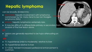 Hepatic lymphoma
can be broadly divided into:
 secondary hepatic involvement with lymphoma:
commonest by far, many tend to be non Hodgkin
lymphoma (NHL)
 primary hepatic lymphoma: extremely rare.
 It may be difficult to differentiate primary vs secondary from
analysis of the liver lesion alone.
CT
 Lesions are generally reported to be hypo attenuating on
CT.
MRI
 T1: hypointense (mild to moderate) relative to liver
 T2: hyperintense relative to liver
 C+ (Gd): transient increased perilesional enhancement is
common.
 
