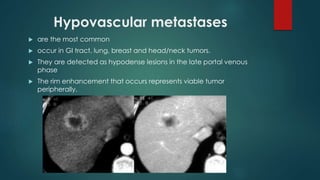 Hypovascular metastases
 are the most common
 occur in GI tract, lung, breast and head/neck tumors.
 They are detected as hypodense lesions in the late portal venous
phase
 The rim enhancement that occurs represents viable tumor
peripherally.
 