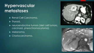 Hypervascular
metastases
 Renal Cell Carcinoma,
 Thyroid,
 neuroendocrine tumors (islet cell tumors,
carcinoid, pheochromocytoma).
 Melanoma,
 Choriocarcinoma.
 