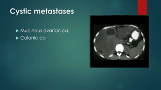 Cystic metastases
 Mucinous ovarian ca,
 Colonic ca
 