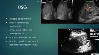 USG
• Variable appearance
• Small (<3cm) usually
hypoechoic
• Larger tumors often are
heterogeneous
• May invade the portal vein
• Most tumors will show central
vascularity on Doppler study.
 