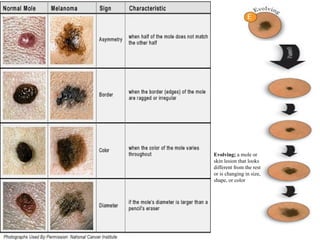 Malignant Melanoma | PPT