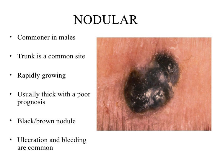 Malignant Melanoma Picture Image on MedicineNet.com