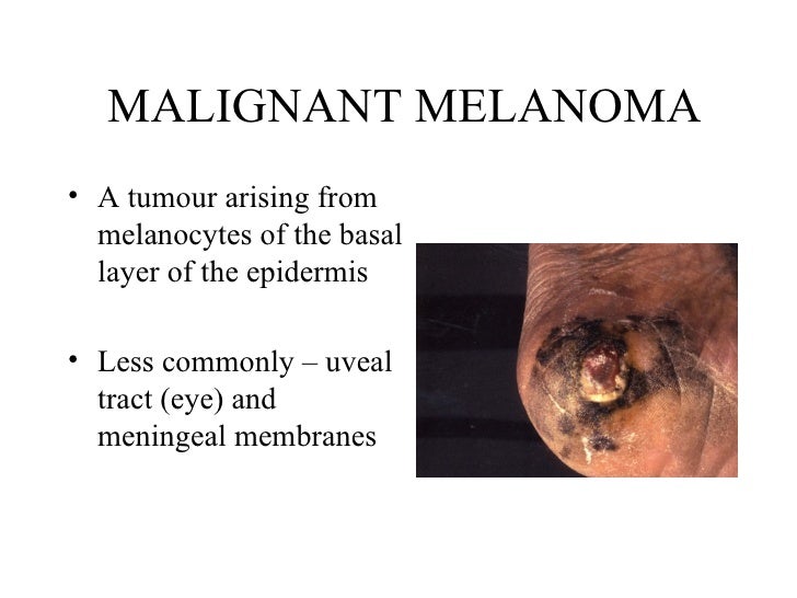 50+ Malignant Melanoma Treatment Ppt PNG