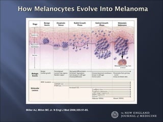 How Melanocytes Evolve Into Melanoma Miller AJ, Mihm MC Jr. N Engl J Med 2006;355:51-65. 