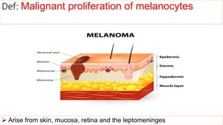  Arise from skin, mucosa, retina and the leptomeninges
Def: Malignant proliferation of melanocytes
 