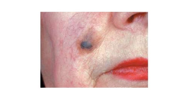 Malignant melanoma