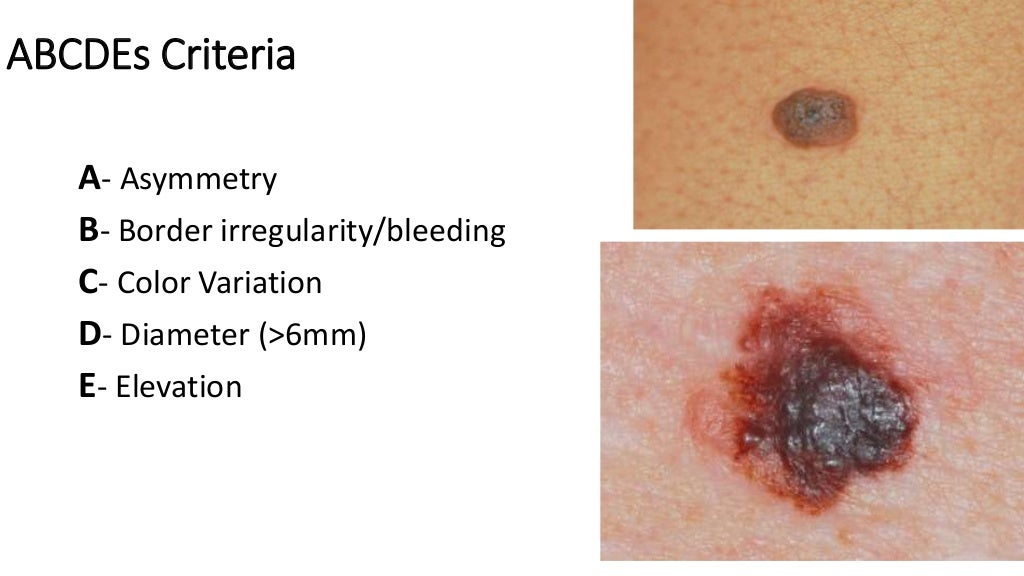 Malignant melanoma