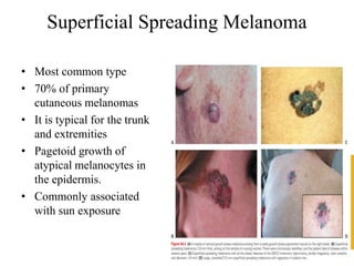 Superficial Spreading Melanoma
• Most common type
• 70% of primary
cutaneous melanomas
• It is typical for the trunk
and extremities
• Pagetoid growth of
atypical melanocytes in
the epidermis.
• Commonly associated
with sun exposure
 