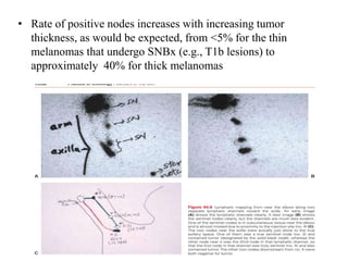 • Rate of positive nodes increases with increasing tumor
thickness, as would be expected, from <5% for the thin
melanomas that undergo SNBx (e.g., T1b lesions) to
approximately 40% for thick melanomas
 