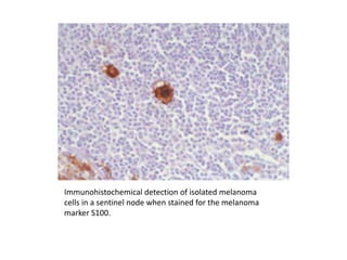 Immunohistochemical detection of isolated melanoma
cells in a sentinel node when stained for the melanoma
marker S100.
 