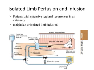 Isolated Limb Perfusion and Infusion
• Patients with extensive regional recurrences in an
extremity
• melphalan or isolated limb infusion.
 