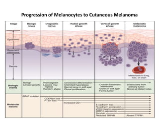 Progression of Melanocytes to Cutaneous Melanoma
 