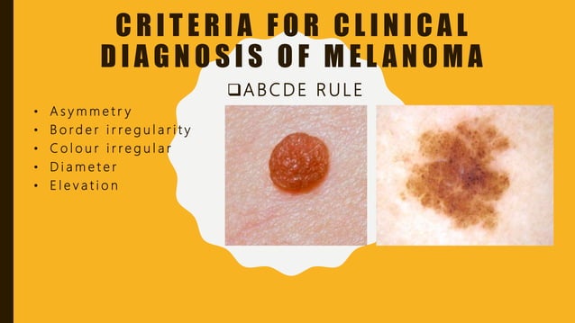 malignant-melanoma-oral-pathology-ppt