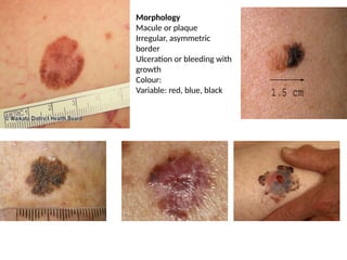 MALIGNANT MELANOMA. It’s management in dermatology | PPTX