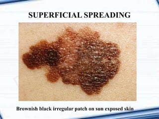 SUPERFICIAL SPREADING
Brownish black irregular patch on sun exposed skin
 