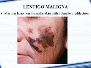 LENTIGO MALIGNA
• Macular lesion on the malar skin with a female predilection
 