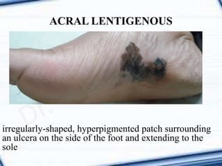 ACRAL LENTIGENOUS
irregularly-shaped, hyperpigmented patch surrounding
an ulcera on the side of the foot and extending to the
sole
 