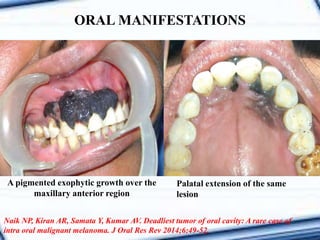 A pigmented exophytic growth over the
maxillary anterior region
Palatal extension of the same
lesion
Naik NP, Kiran AR, Samata Y, Kumar AV. Deadliest tumor of oral cavity: A rare case of
intra oral malignant melanoma. J Oral Res Rev 2014;6:49-52.
ORAL MANIFESTATIONS
 