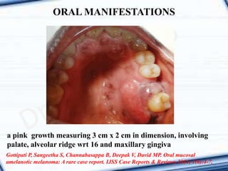 a pink growth measuring 3 cm x 2 cm in dimension, involving
palate, alveolar ridge wrt 16 and maxillary gingiva
ORAL MANIFESTATIONS
Gottipati P, Sangeetha S, Channabasappa B, Deepak V, David MP. Oral mucosal
amelanotic melanoma: A rare case report. IJSS Case Reports & Reviews 2014; 1(6):4-7.
 