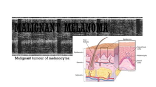 Malignant melanoma: everything you need to know l.pptx