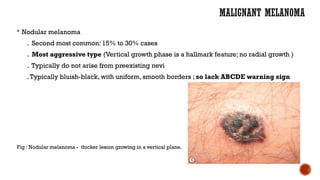 Malignant melanoma: everything you need to know l.pptx