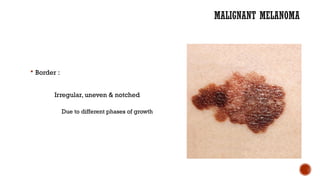Malignant melanoma: everything you need to know l.pptx