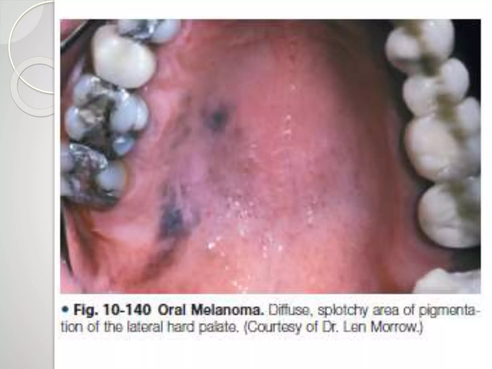 Malignant melanoma of the oral cavity | PPTX