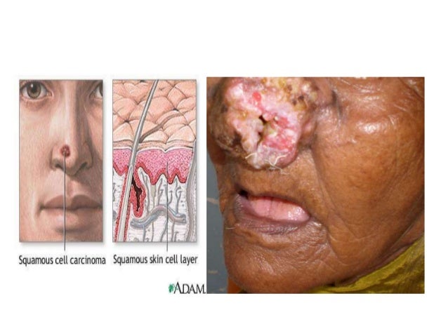 Malignant neoplasms of nose diagram of nasal glands 