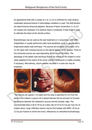 Malignant neoplasms of the oral cavity | PDF