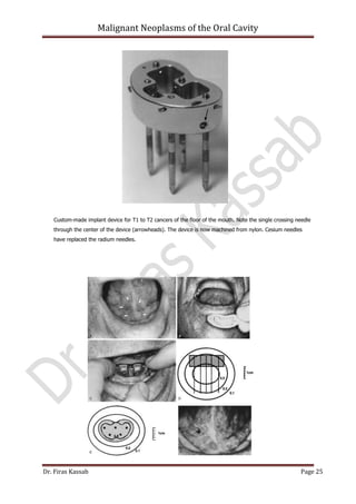 Malignant neoplasms of the oral cavity | PDF