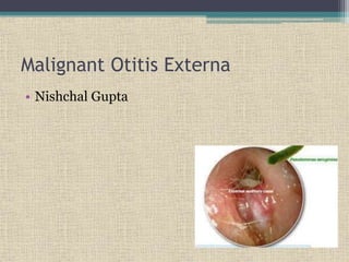 Malignant Otitis Externa
• Nishchal Gupta
 