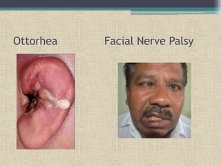 Ottorhea Facial Nerve Palsy
 