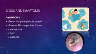 SIGNS AND SYMPTOMS
SYMPTOMS
• Excruciating ear pain (noctural)
• Purulent Discharge from the ear
• Hearing loss
• Fever
• Headache
 