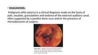 • DIAGNOSIS:
Malignant otitis externa is a clinical diagnosis made on the basis of
pain, exudate, granulations and oedema of the external auditory canal,
often supported by a positive bone scan and/or the presence of
microabscesses at surgery.
 