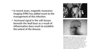 • In recent years, magnetic resonance
imaging (MRI) has added much to the
management of this infection.
• Increased signal in the soft tissues
beneath the skull base as a result of
inflammation does much to establish
the extent of the disease.
 