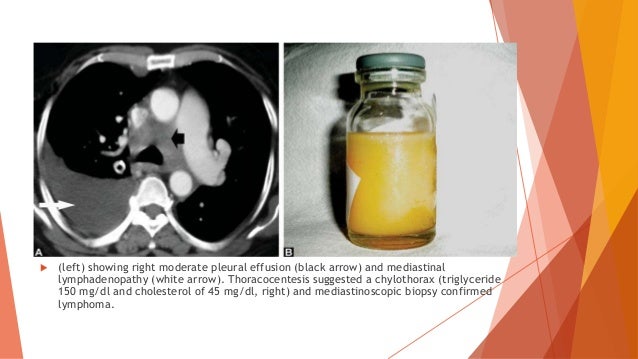 Pleural Effusion Lecture Note by Gboneme Sandra