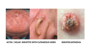 ACTIN / SOLAR KERATITIS WITH CUTANEOUS HORN KERATOCANTHOMA
 