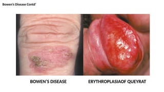 Bowen’s Disease Contd’
BOWEN’S DISEASE ERYTHROPLASIAOF QUEYRAT
 