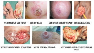 VERRUCOUS SCC FOOT SCC OF FACE SCC OVER SSG OF SCALP SCC LABIAL SKIN
SCC OVER AMPUTATION STUMP SCAR SCC OF DORSUM OF HAND SCC/ MARJOLIN’S ULCER OVER BURNS
SCAR
 