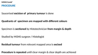 MOHS Contd’
PROCEDURE
Saucerised excision of primary tumour is done
Quadrants of specimen are mapped with different colours
Specimen is sectioned by Histotechnician from margin & depth
Studied by MOHS surgeon / Histologist
Residual tumour from relevant mapped area is excised
Procedure is repeated until clear margin & clear depth are achieved
 